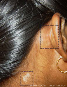 Vitiligo-Before